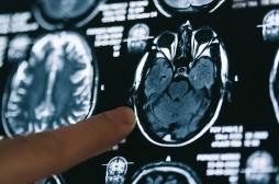 Alzheimer : une mauvaise oxygénation du cerveau en cause ?