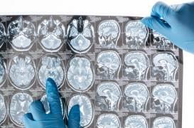 Dépression et anxiété sociale unies dans le cerveau