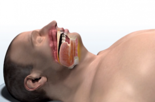 Sleep apnea: the United States authorizes a revolutionary implant 