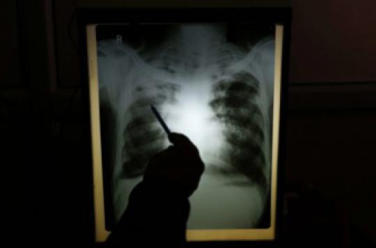 Tuberculosis: the situation is improving, except in Seine-Saint-Denis