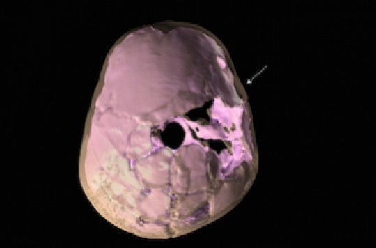 Head trauma: the oldest case dates back to the Paleolithic