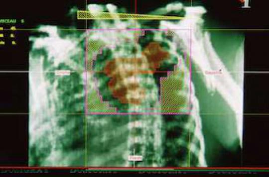 Lung cancer: 30% of deaths three months after diagnosis