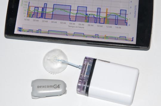 The French artificial pancreas marketed in the United States