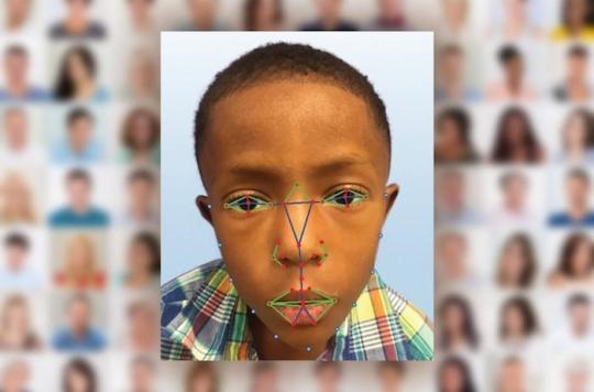 Rare diseases: facial recognition to reduce diagnostic guesswork