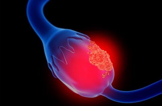 Ovarian cancer: treatment helps preserve fertility