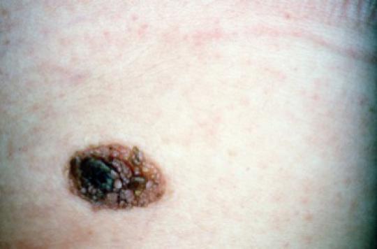 Melanoma: immunotherapy limits recurrence and improves survival