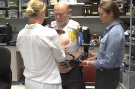 An amputee man controls his bionic arms by thinking