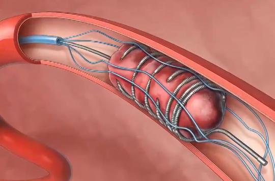 Severe stroke: a revolutionary treatment to reduce disability