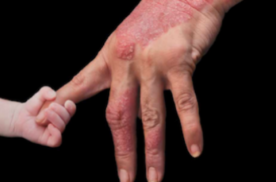 Psoriasis: more than two million French people affected
