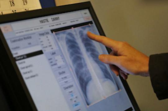 Lung cancer can lie dormant for 20 years