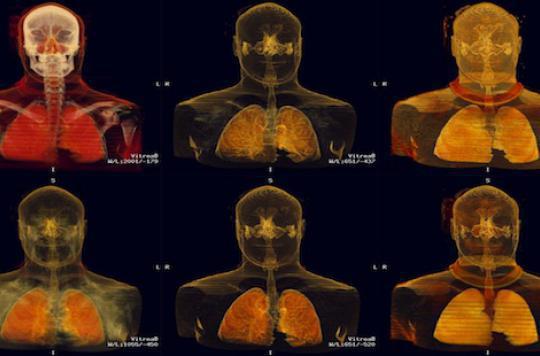 Lung cancer: tripling the number of cures 