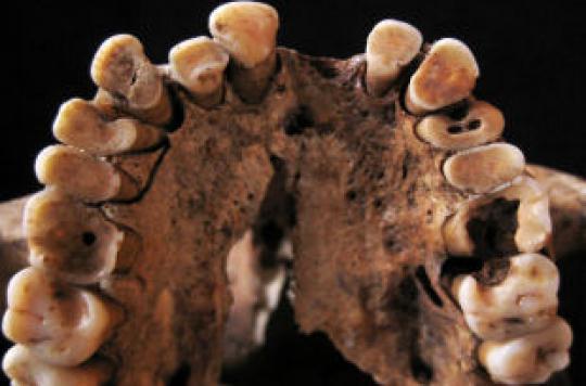 Cavities and bad breath go back to prehistoric times