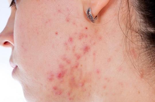 Acne: a vaccine could strengthen the therapeutic arsenal