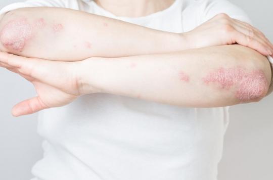 Psoriasis: the severity of the disease is linked to a protein 