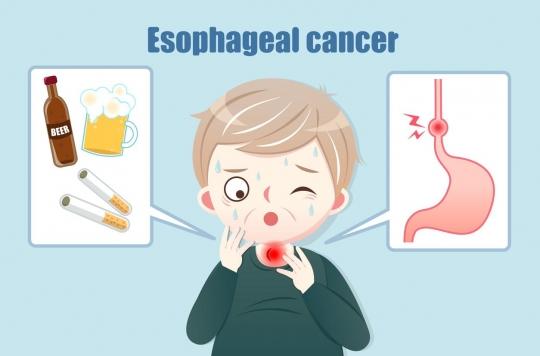 Esophageal cancer cases tripled in people under 50