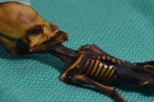 Atacama’s alien skeleton?  A little girl with a body deformed by a genetic disease …