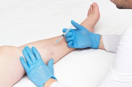 Varicose veins: “Sclerotherapy sessions must be done regularly”