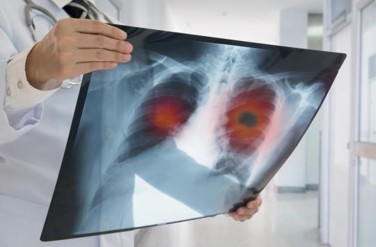 Cardiovascular diseases: thanks to AI, the risk detected with lung cancer screening