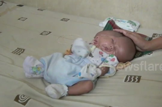 Indonesie Un Bebe Nait Avec Deux Visages Et Deux Cerveaux