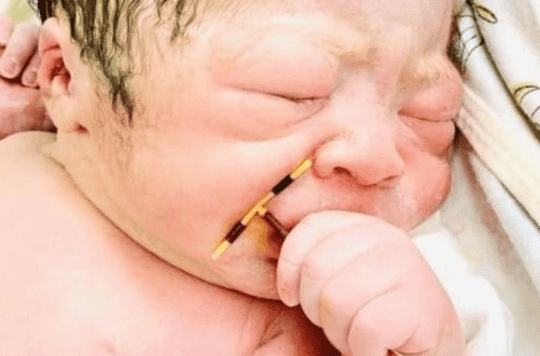 In Vietnam, a baby is born with an IUD in his hand, the photo goes around the world 