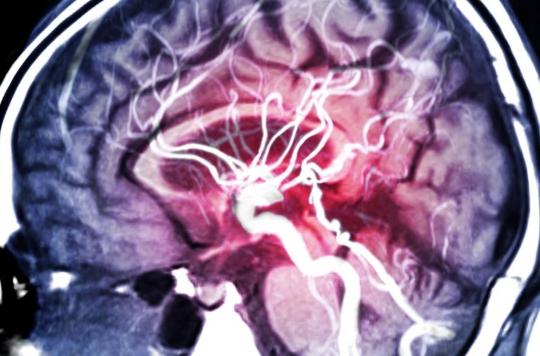 Between two twins, the risk of stroke is multiplied by 2.5 for the one who smokes