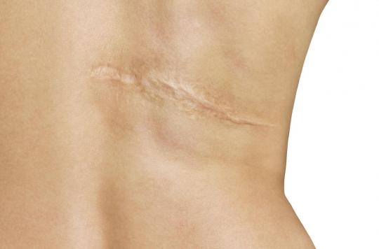 How to prevent a scar from becoming “hypertrophic”?