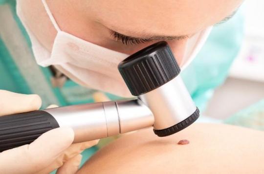 Melanoma: it is now possible to have your moles checked in pharmacies