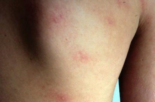 Urticaria: 20% of the world’s population is itchy