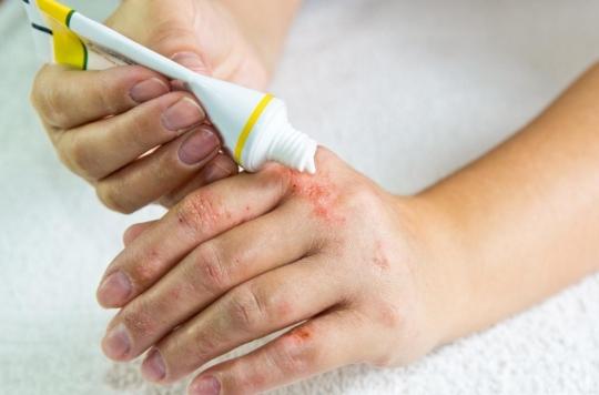 Eczema or dry hands: the signs that make the difference