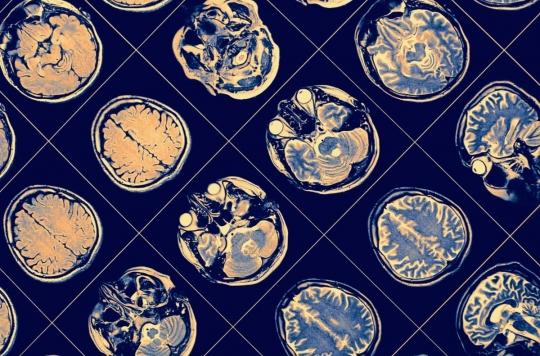 Alzheimer’s disease: should treatments be based on gender?