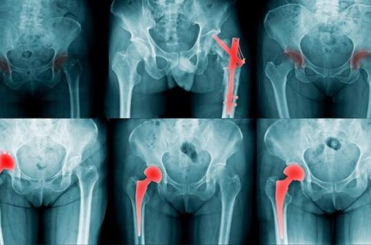 Osteoporosis: the risk factors for fractures better identified