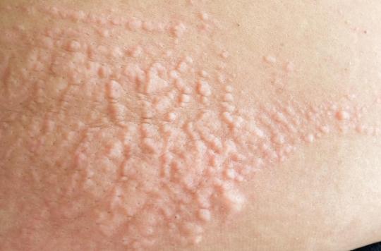 Urticaria and cold: these people in danger when the temperatures drop too much