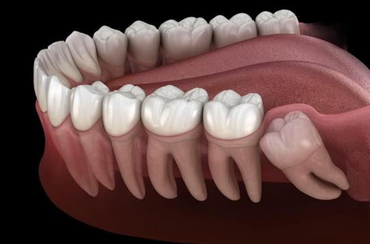 To better appreciate the taste… have your wisdom teeth pulled!