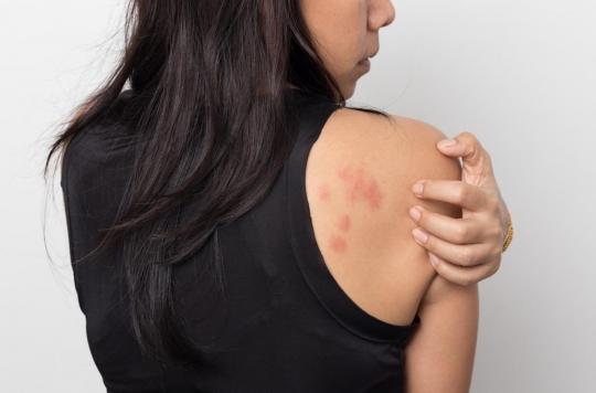 Coronavirus: dermatologists warn of possible skin symptoms