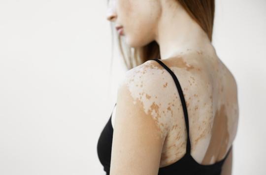 Vitiligo: soon an effective treatment to repigment the skin