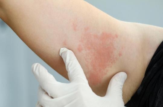 Delayed skin reactions after Morderna vaccine injection