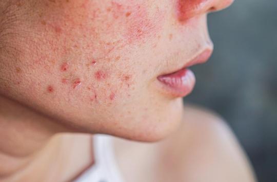 Acne: 29 new genes responsible for its appearance have been identified