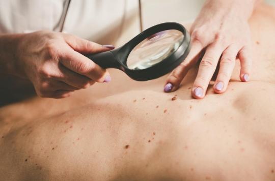 Melanoma: a diet rich in fiber could improve the effectiveness of immunotherapy 