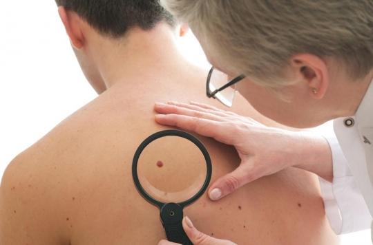 Skin cancer: early detection increases chances of survival