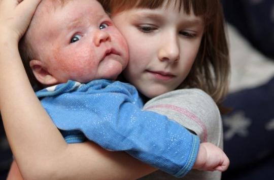 Eczema Infantile Une Maman Soigne Son Bebe Avec Une Recette Insolite