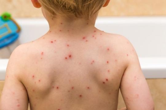 Chicken pox: epidemic in a school where half of the children are not vaccinated for “religious reasons”