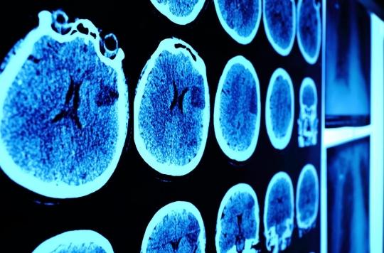 Childhood brain cancer: a promising new treatment