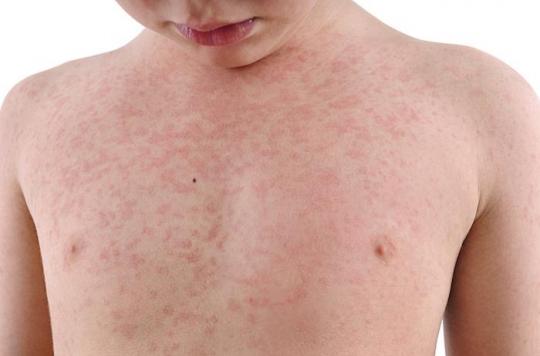 Rubella becomes a reportable disease like tuberculosis or cholera