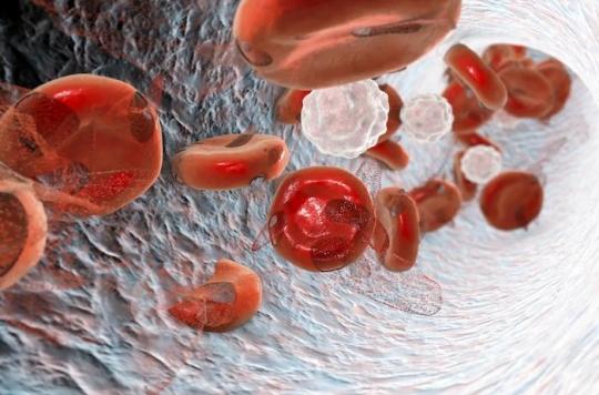 Hereditary anemia: gene therapy revolutionizes the treatment of beta-thalassemia