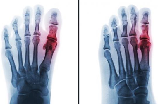 Gout: increased cardiac mortality with febuxostat