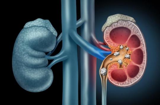 Kidney stones: 5 antibiotics promote urolithiasis