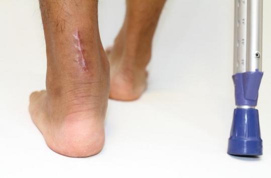 Rupture of the Achilles tendon: when should you operate?