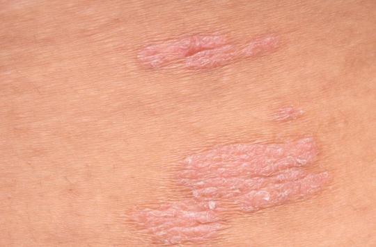 Eczema could be caused by your gut microbiota