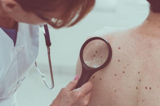 Melanoma: immunotherapy before surgery limits the risk of relapse