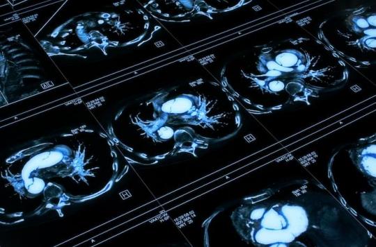 Aneurysm and aortic dissection augmented by antibiotic